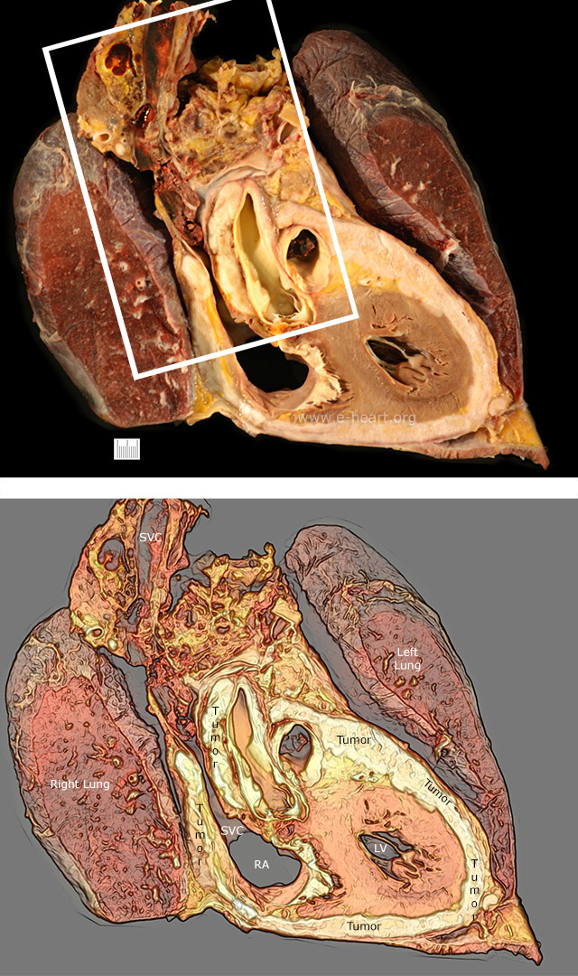 Pericardial Mesothelioma gross 001